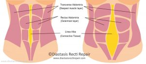 DiastasisRecti