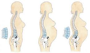 lordosis lumbar