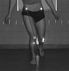 rodilla valgo